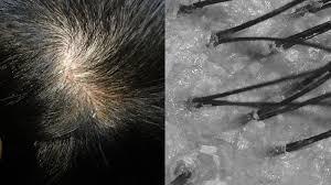 出门头皮屑多怎么去除最简单方法,头皮屑太多怎么去除最简单方法