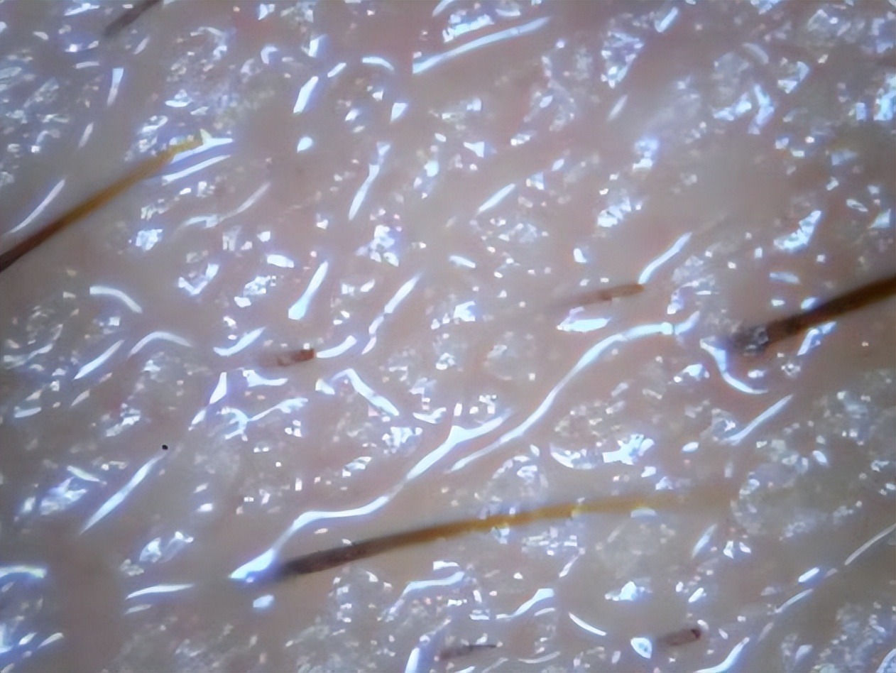 脸上起皮了是怎么回事,脸上起皮是什么原因怎么办