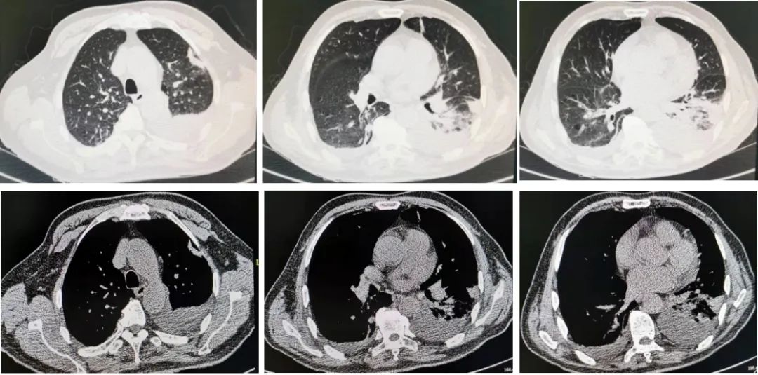反复发烧但是拍片显示轻微肺炎,一直高烧39-40是肺炎么