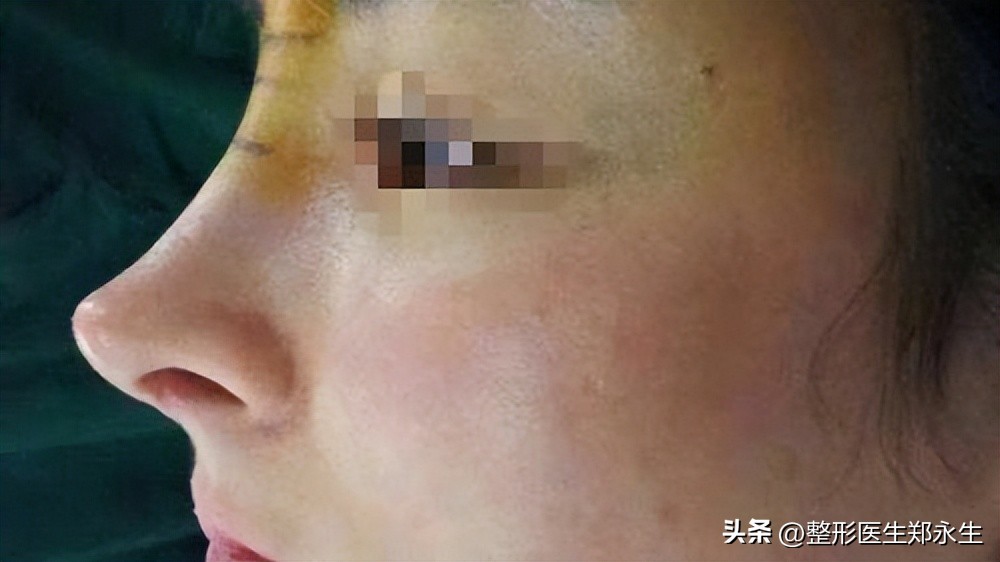 修复隆鼻不满意最佳取出时间,如何进行隆鼻失败修复