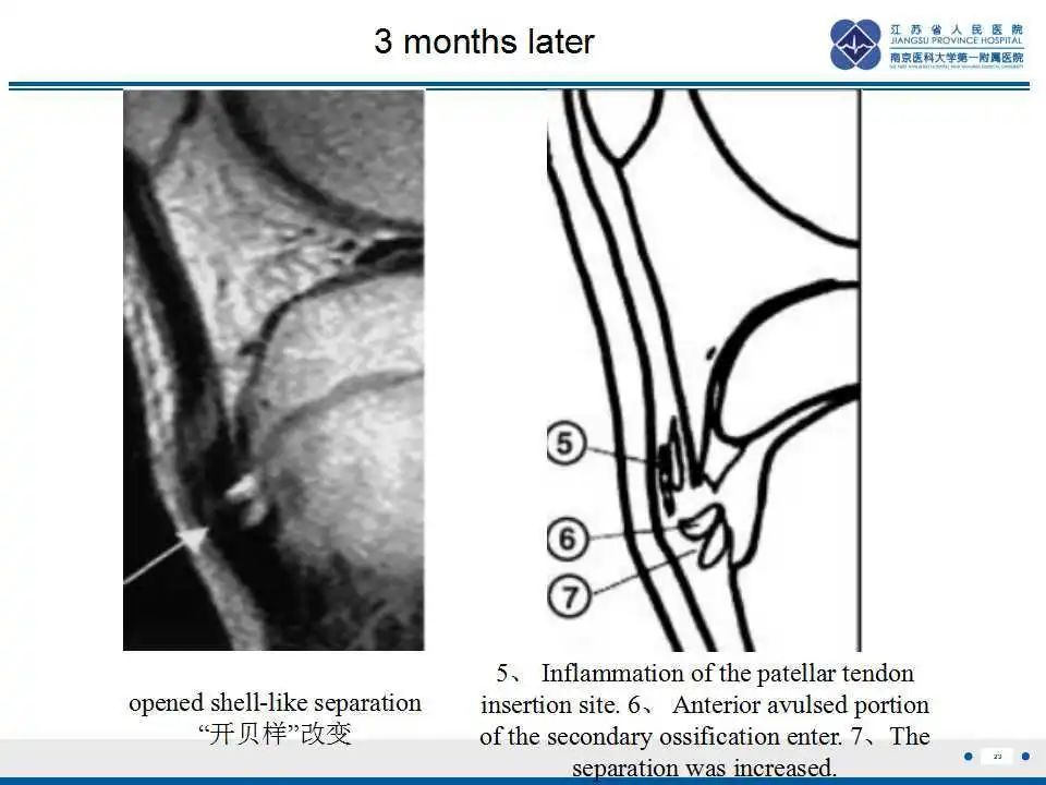 胫骨结节软骨炎要怎么治疗,胫骨结节骨软骨炎会癌变吗