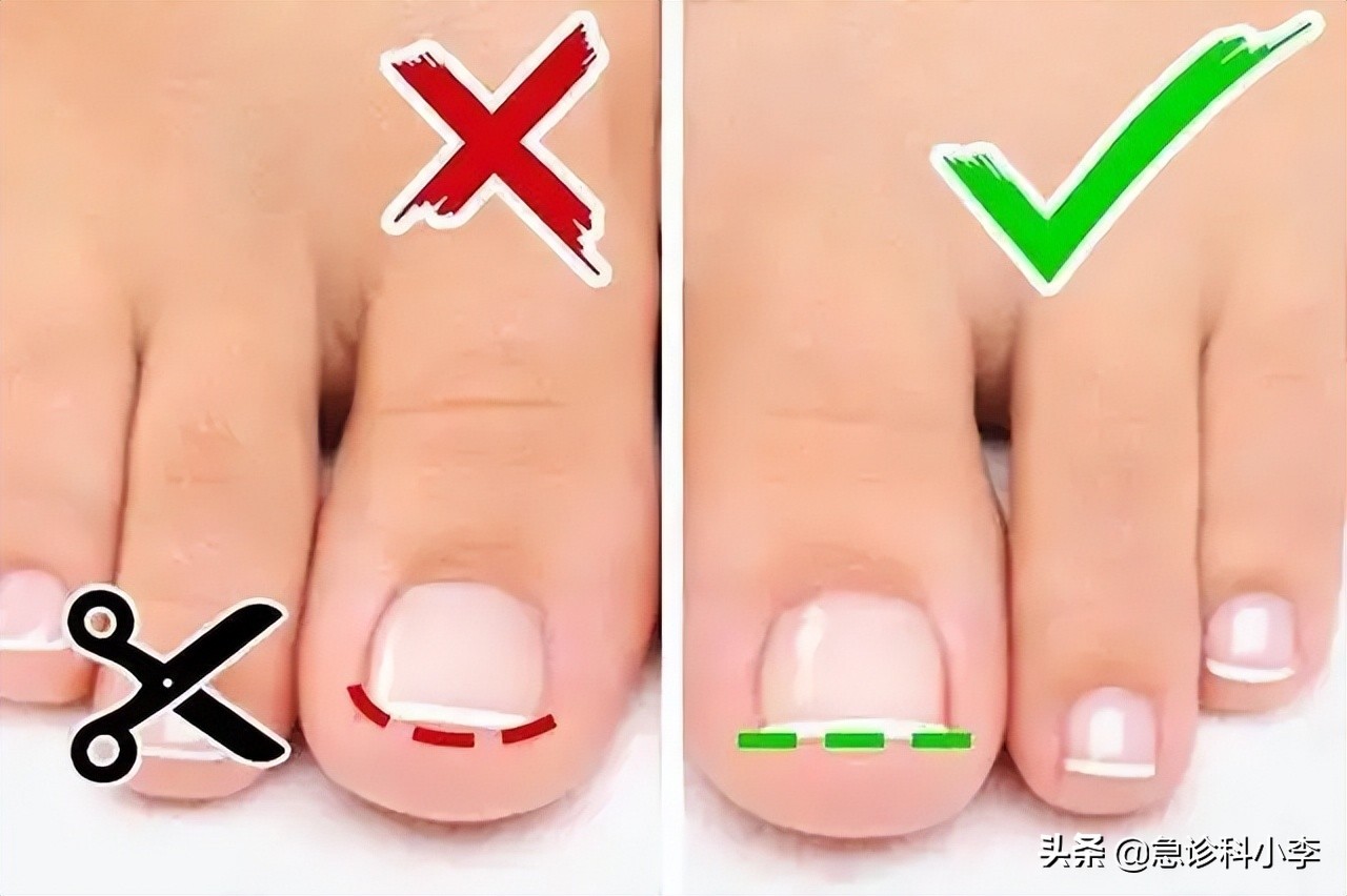 脚趾甲老往肉里钻,脚趾甲总是往肉里钻怎么办