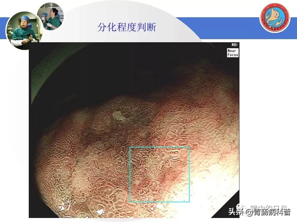 胃癌可以做内镜手术吗,早期胃癌内镜手术后追加外科手术