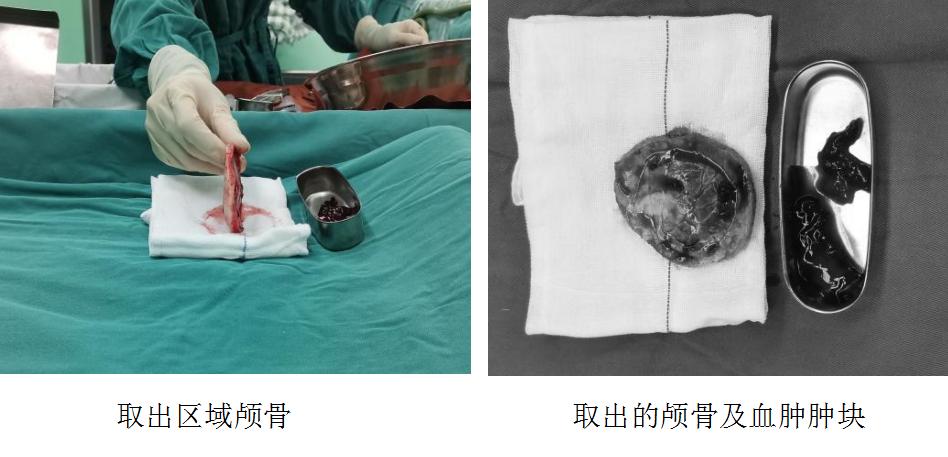 飞来横祸，初中生脑袋被铅球砸出一个“坑”