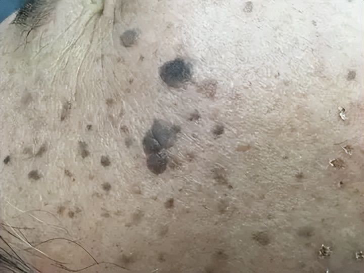 老年色素沉着斑怎么消除,色素沉着老年斑能去除吗