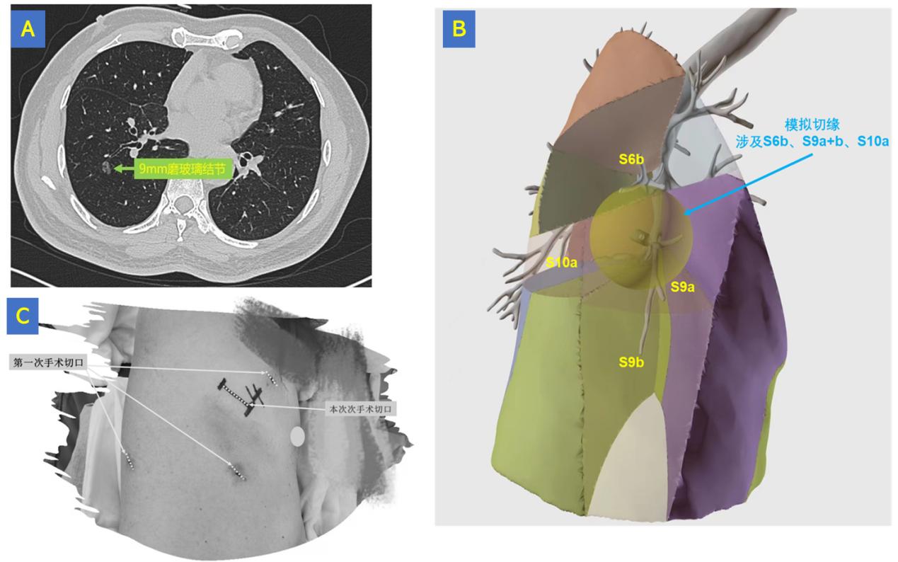 华西胸外科手术,华西肺癌中心和华西胸外科