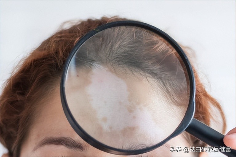 为什么白斑初期像疤一样,白斑怎么治才能彻底消除用什么药