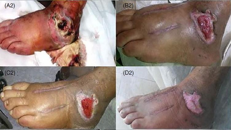 全球干细胞最新临床进展,干细胞再生医学现状