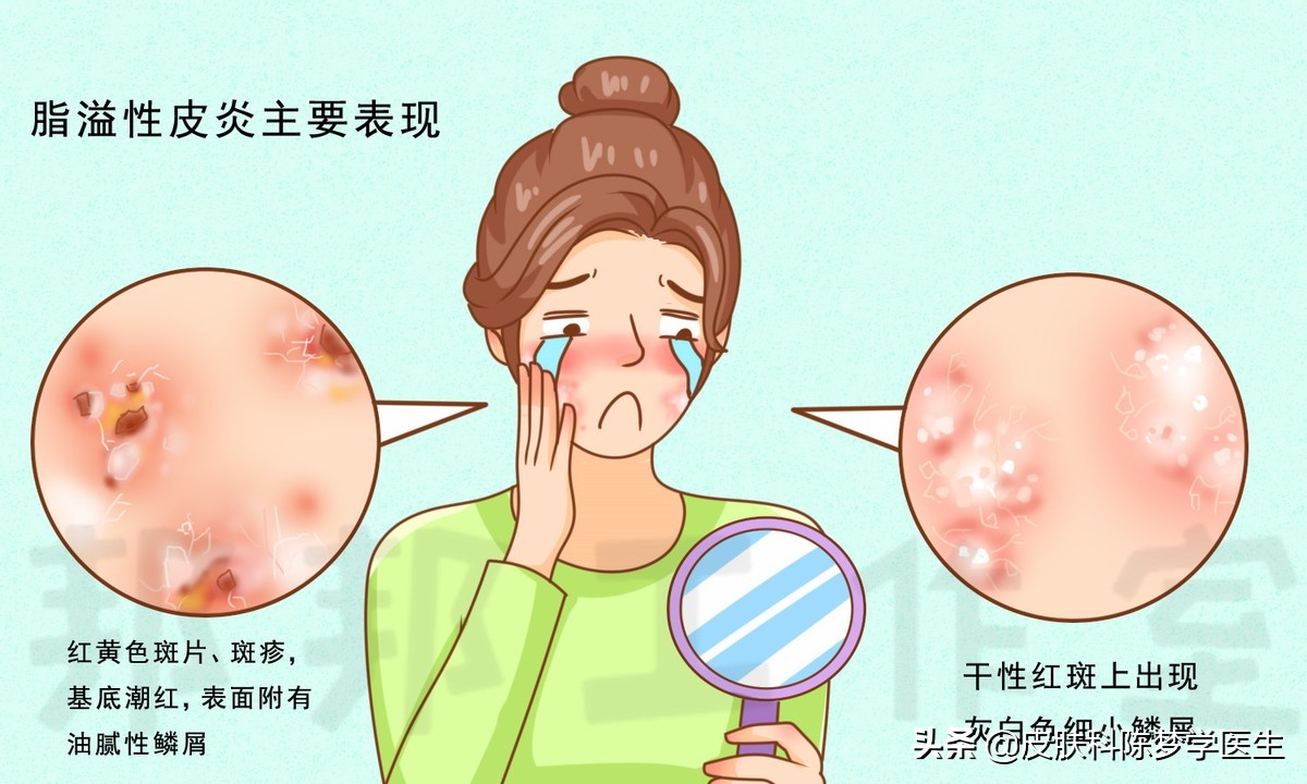 脸上红斑痒起皮屑是红斑狼疮吗,脸上有银屑病红斑怎么办