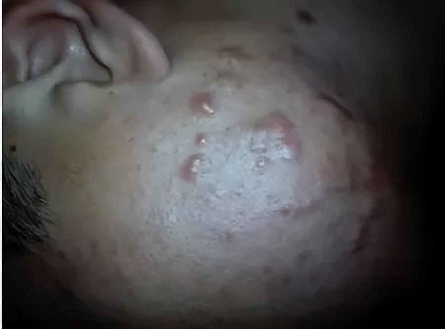 治疗痘印最有效的医美手段,脸部痘印中医能治疗嘛