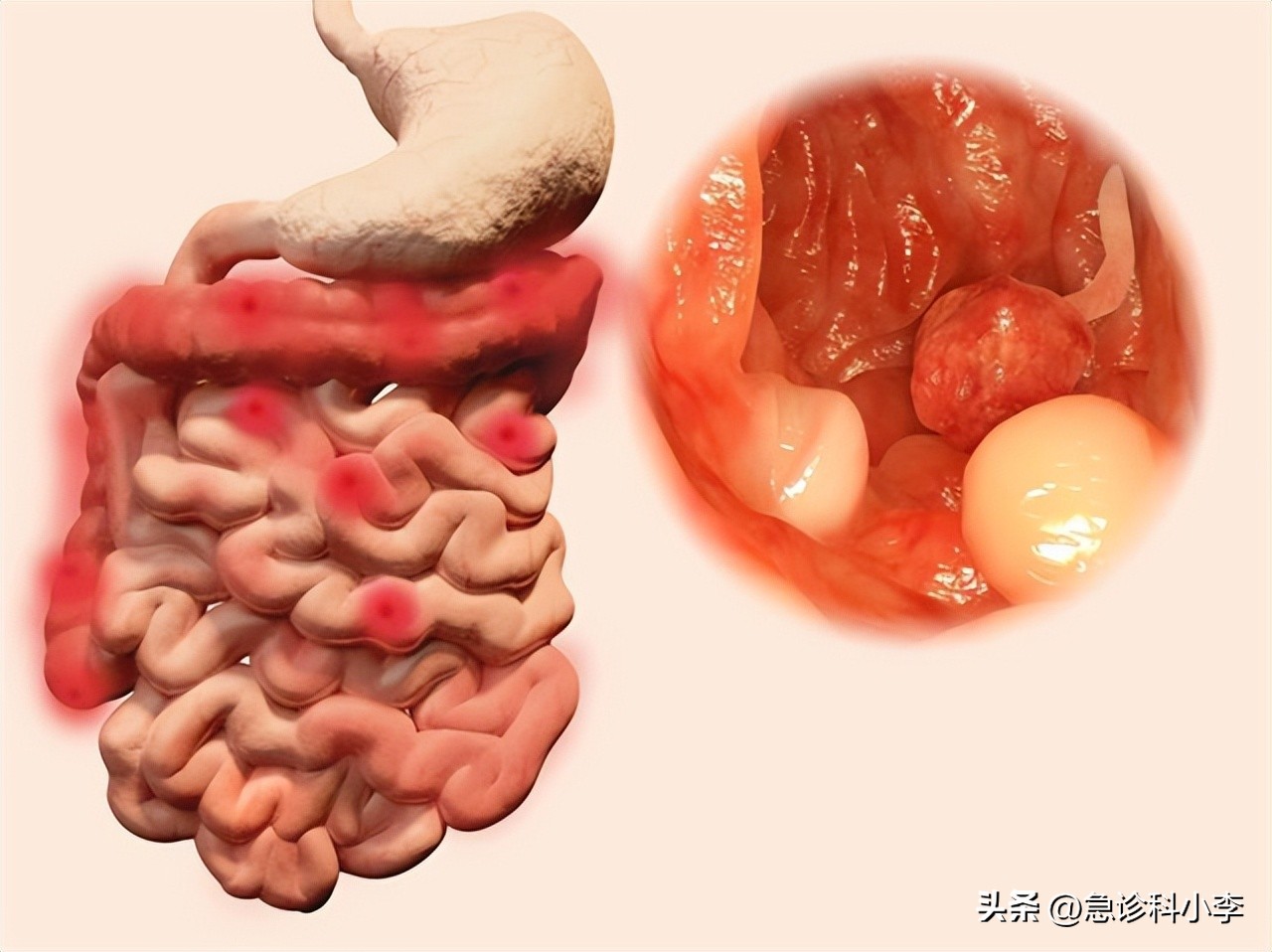 肠道为什么反复长息肉如何预防,如果肠道长息肉身体会有哪些反应