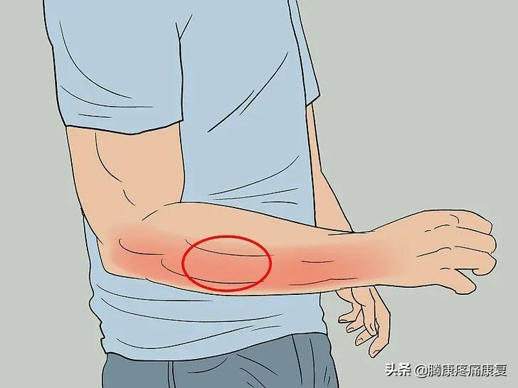 前臂桡侧疼痛怎么缓解,前臂疼痛按摩如何缓解