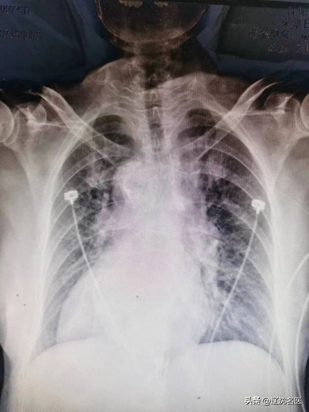 心脏长在右边，突发心梗咋救？！沈阳十院心脏中心救援纪实