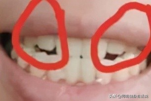 牙齿快暴露牙本质了怎么修复,牙齿已经露出牙本质了怎么修复