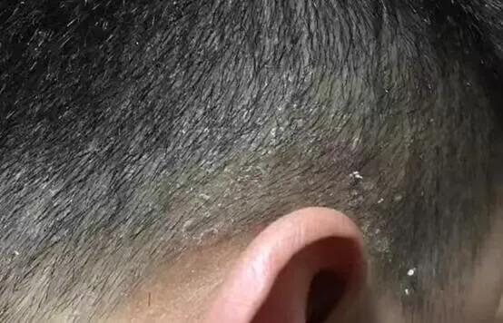 头皮屑多洗头的正确方法,头皮屑怎么处理用什么洗头最佳
