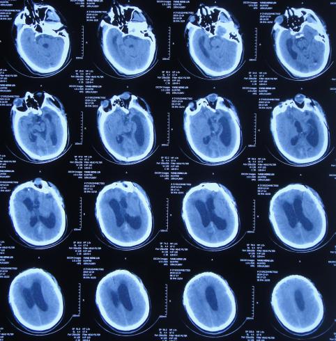 脑外伤后硬膜下积液颅骨修补,颅骨修复手术失败导致脑积水