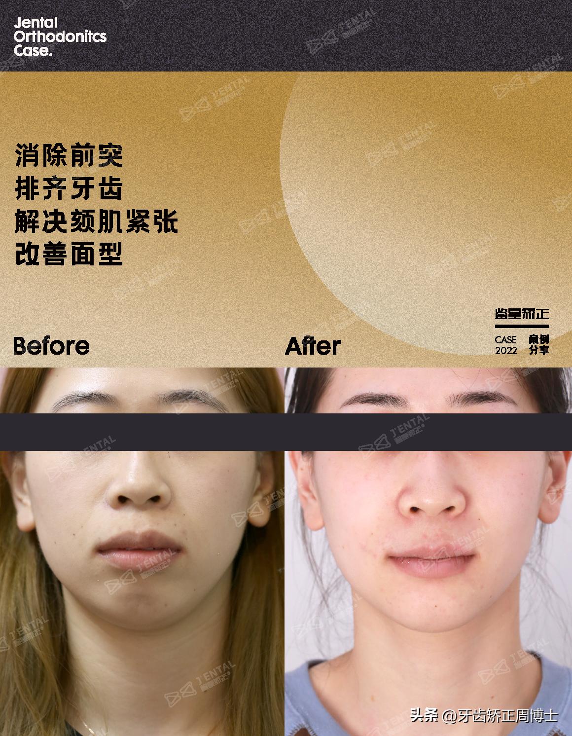 骨性前突正畸后多长时间有效果,牙性下巴后缩可以戴牙套改善吗