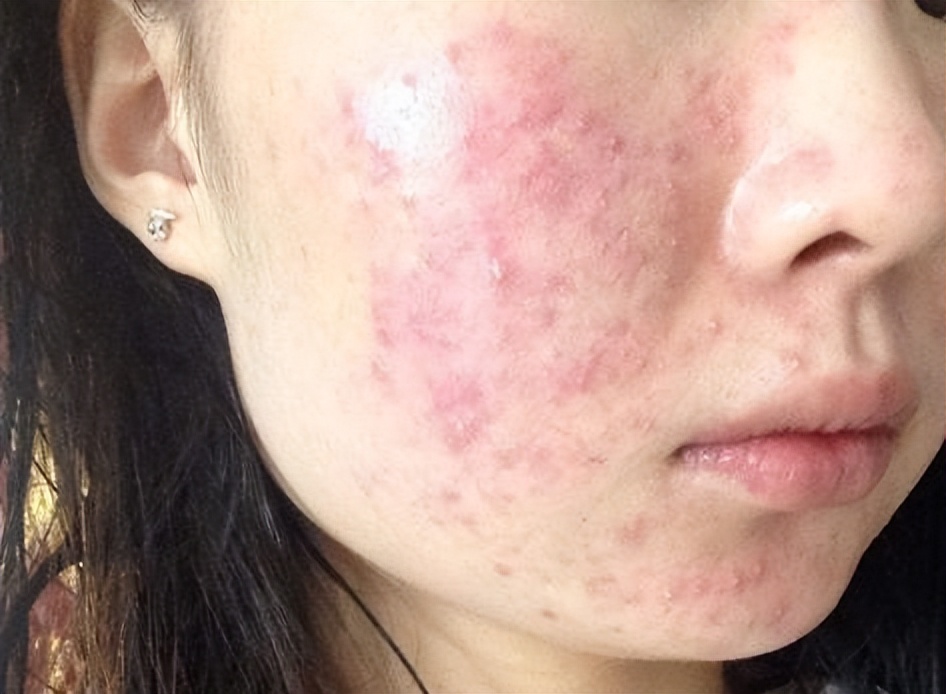 炎症会发展成癌吗,炎症发展到癌的过程