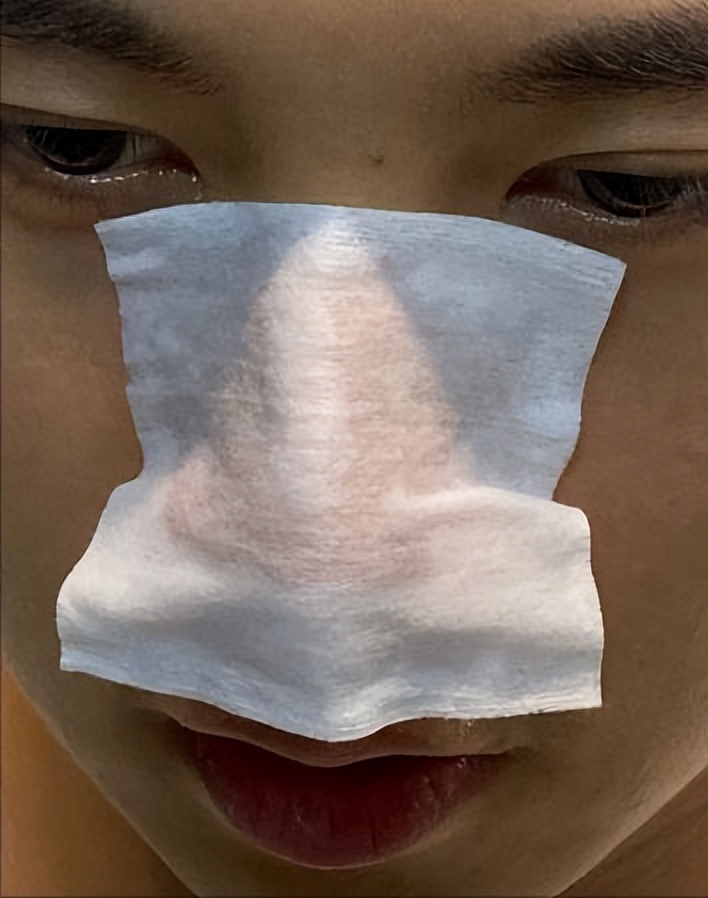 鼻子上有白白的小点可以挤吗,鼻子上黑黑的小点点怎么去除