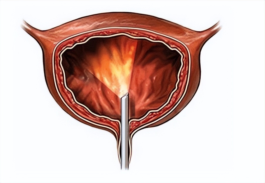 膀胱炎疼痛难忍怎么办,间质性膀胱炎的中药治疗方法