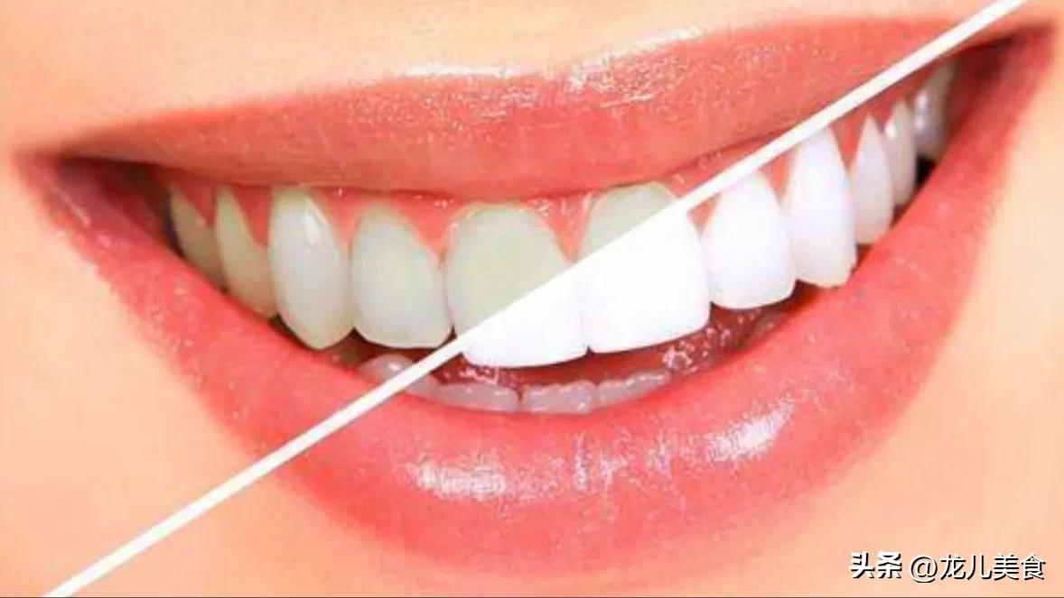 不经常刷牙牙齿黄洗牙管用吗,牙齿发黄用什么洗牙最好