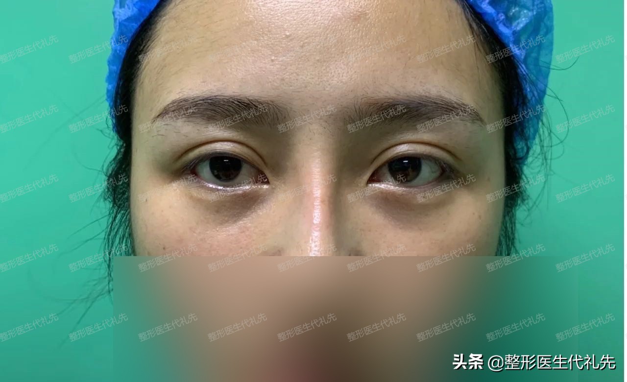 欧式双眼皮可以做成扇形双眼皮吗,平行双眼皮可以修复扇形双眼皮吗