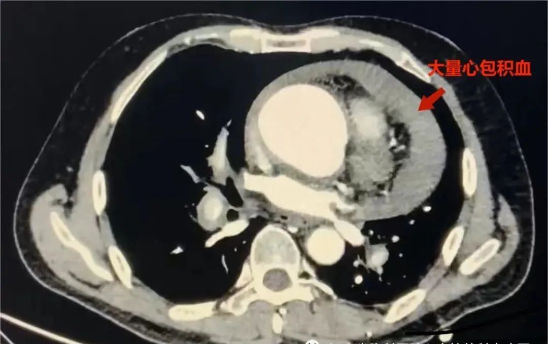 突发主动脉夹层破裂抢救无效去世,急性主动脉夹层经24天没醒死亡