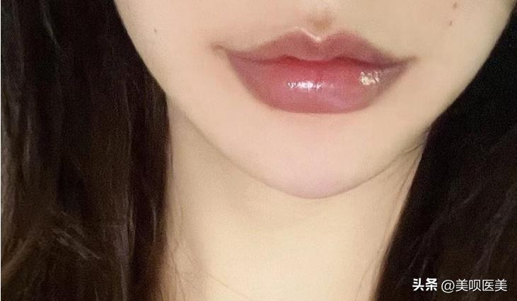 假玻尿酸毁容案例,玻尿酸注射如何避免网红脸