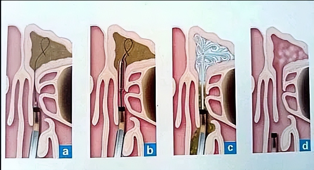 脑袋疼流鼻涕鼻塞怎么办,鼻塞流脓鼻涕鼻涕倒流头疼
