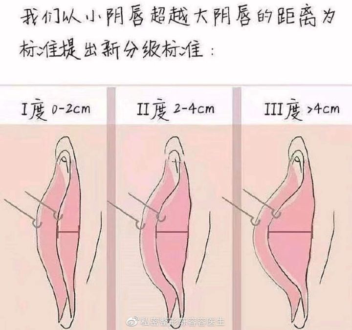 有没有必要做私密整形,你有没有必要整容