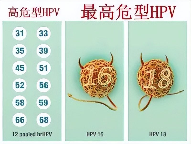 尖锐性湿疣和hpv哪个更严重,尖锐性湿疣是属于hpv高危还是低危