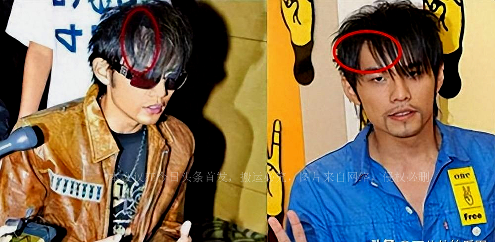 秃头潘玮柏,明星是怎么解决脱发的