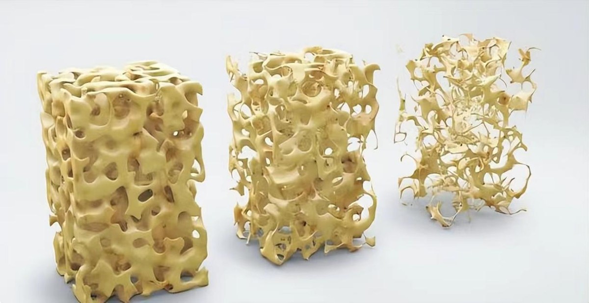 增加骨密度就是增加钙吗,吃什么增长骨密度快