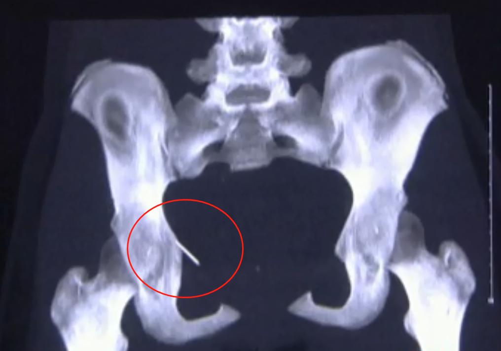 6岁女童腹痛检查出来母亲傻眼,重庆女子腹痛