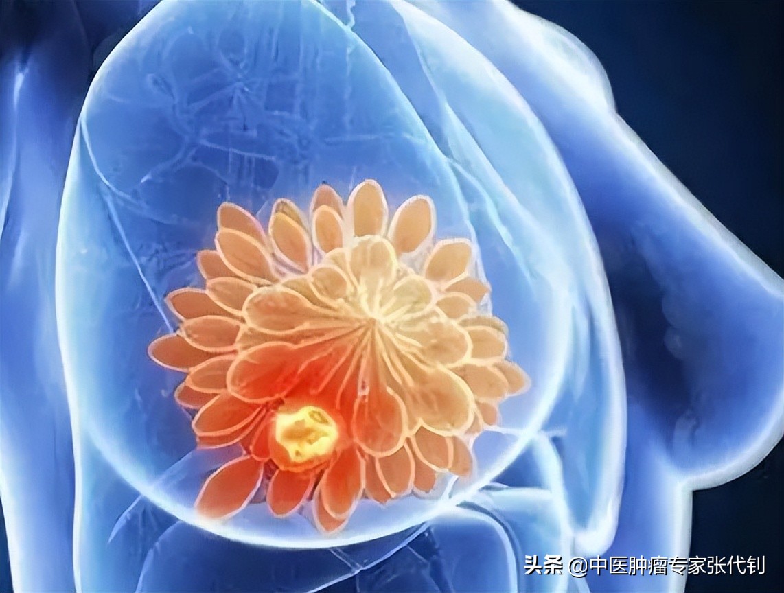 乳腺重度不典型增生如何预防癌变,乳腺增生导管扩张一年了会癌变吗