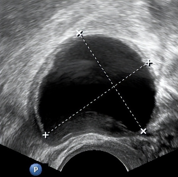 超声显示子宫肌瘤卵巢囊肿,显微镜下的卵巢囊肿