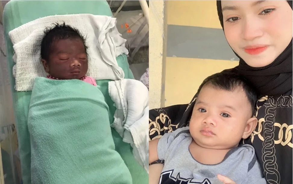 婴儿出生头卡住受伤了,宝宝出生时被卡住