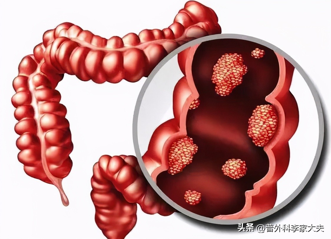 结肠癌肝转移最好的中医是谁,结肠癌肝转移老人抗癌视频