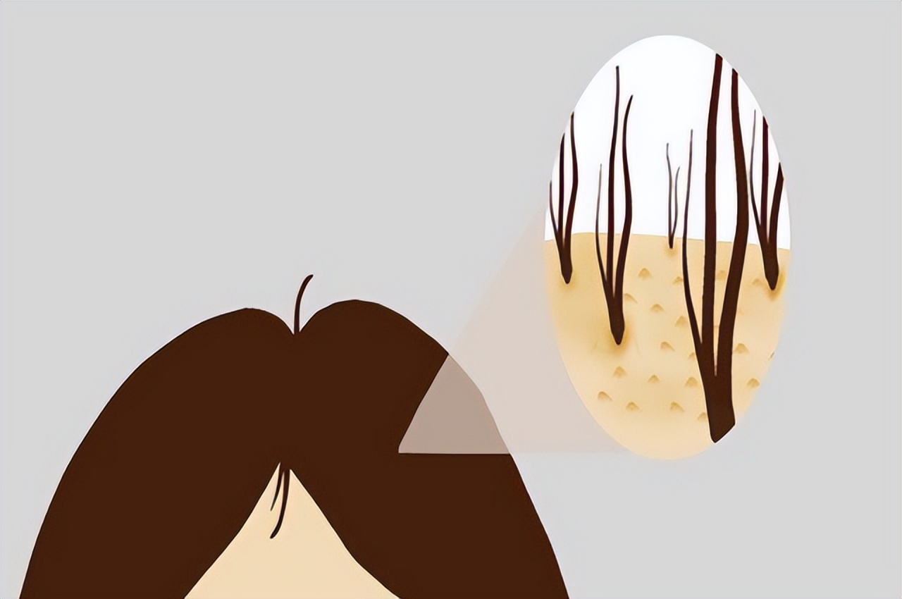 头皮上长疙瘩和脓包怎么治,头皮上总是长疙瘩和脓包如何根治