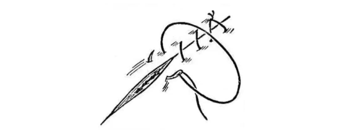 外科缝合技巧你熟练吗,外科缝合术的操作步骤