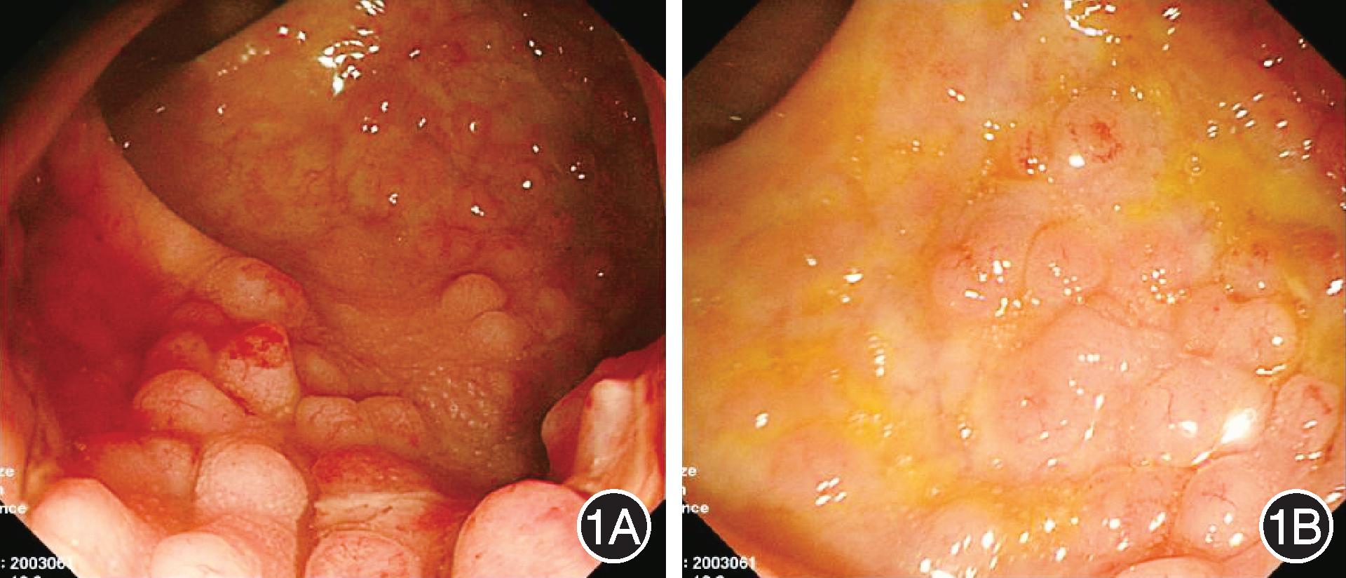 沙眼衣原体感染直肠炎,衣原体感染会引起直肠炎吗