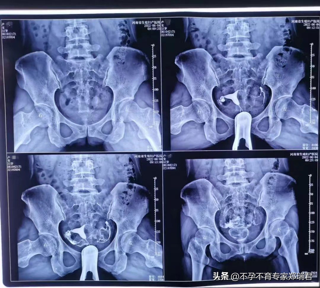 输卵管不通，成功治愈并怀孕