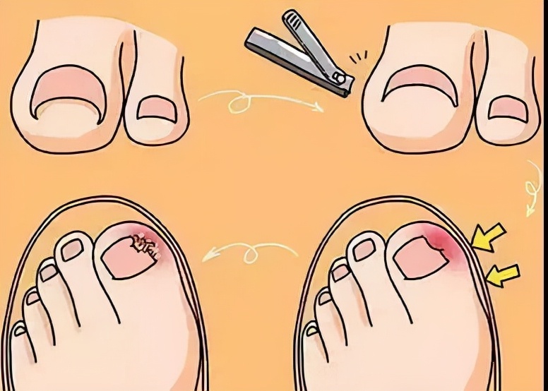 脚趾甲往肉里长又疼又痒教你一招,脚趾甲没有甲沟炎为什么一碰就疼