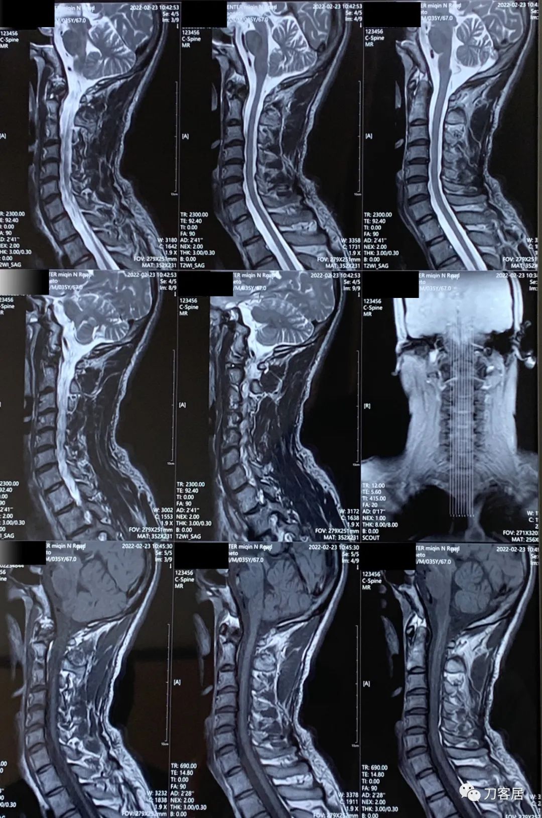腰椎间盘突出压迫腿疼看神经内科,腰椎间盘突出看骨科还是神经内科