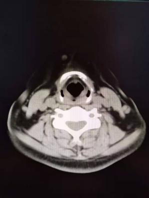 宫颈癌复查有肺部新增小结节,甲状腺结节和宫颈癌有关系吗