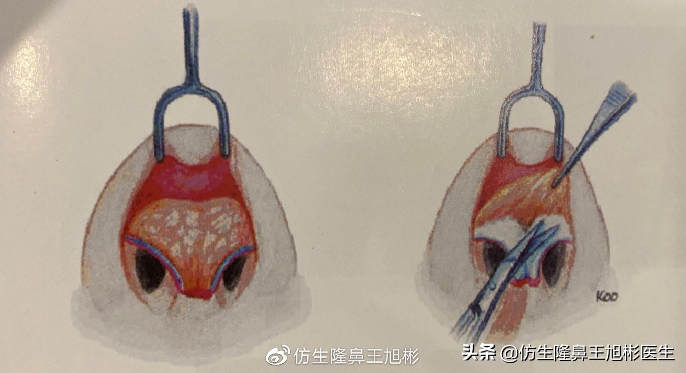 做一次鼻头缩小要多少钱好,可以只做鼻头缩鼻翼吗