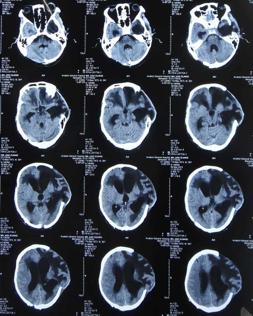脑外伤开颅手术后继发癫痫,开颅术后颅内感染
