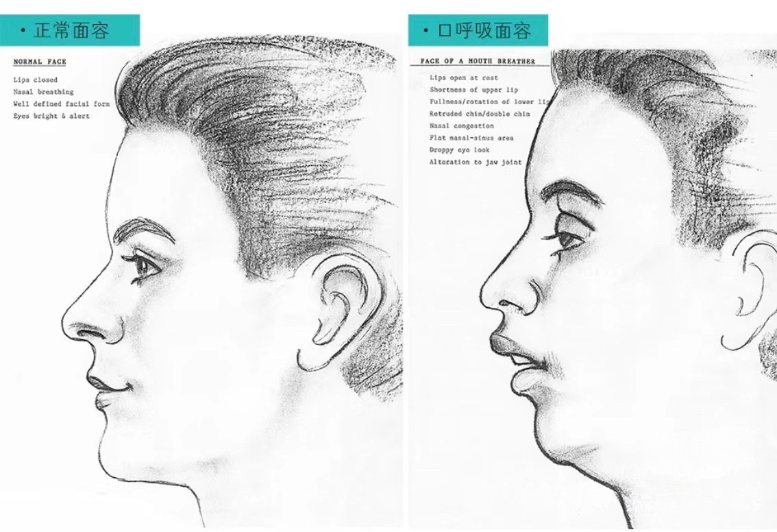 如何戒掉口呼吸,教你判断自己是不是口呼吸