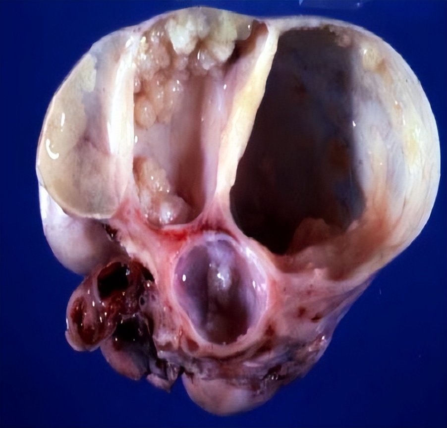 超声显示子宫肌瘤卵巢囊肿,显微镜下的卵巢囊肿