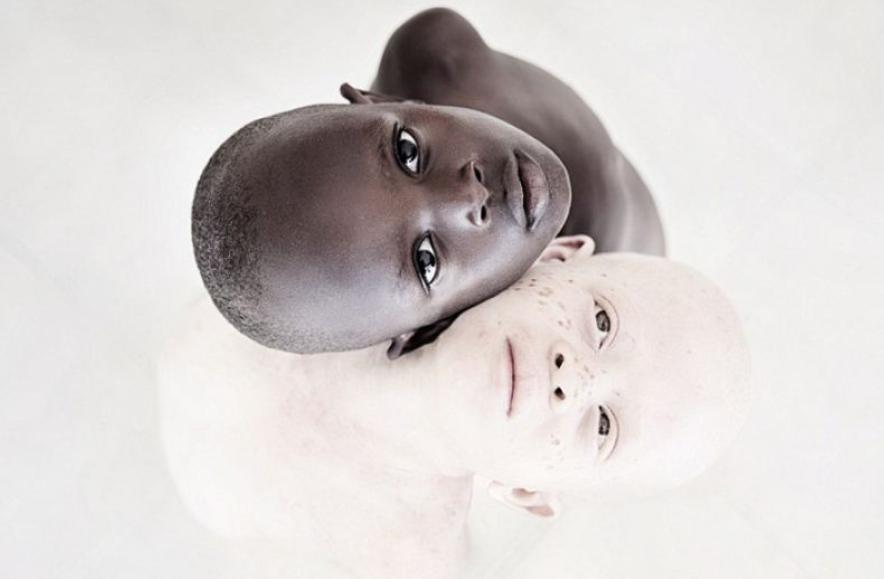 非洲最特殊的人群：血液堪比黄金，遗骸卖上百万，却无法健康成长